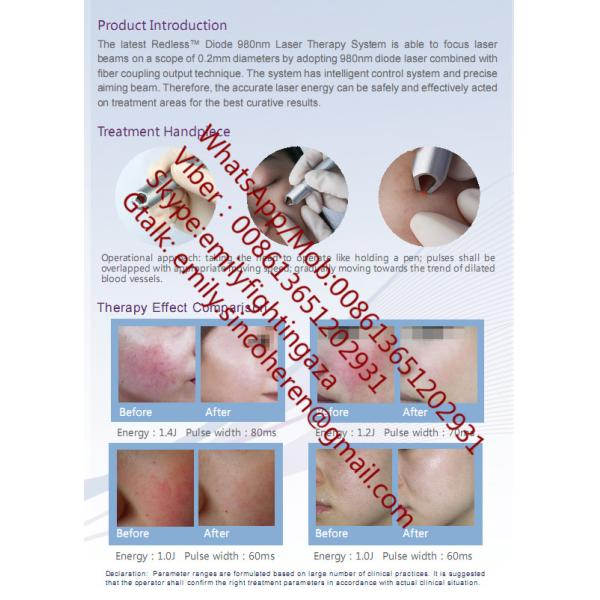 980nm Vascular removal laser Redless Beijing Sincoheren  Vascular Lesions Vbeam