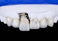 Une couronne d'implant dentaire en titane pour un sourire naturel