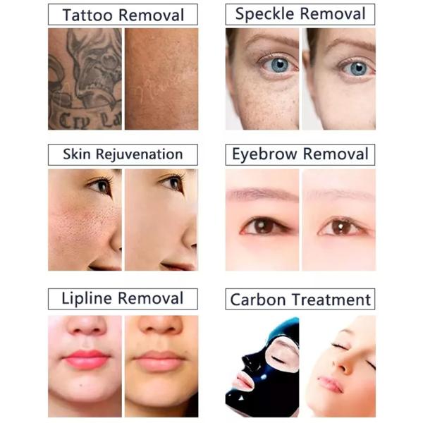 2 In 1 755nm 1064nm Diode Laser Hair Removal System Laser Tattoo Removal Equipment