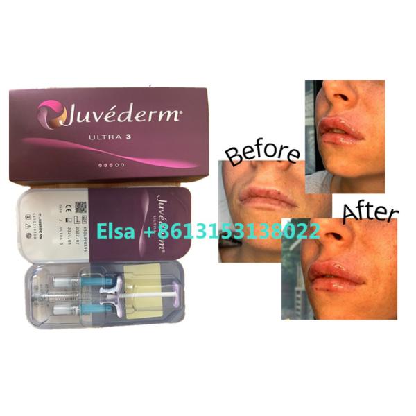 Enchimento cutâneo de Juvederm dos produtos cosméticos para os bordos da cara