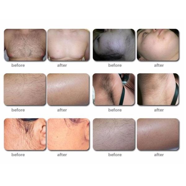 480-950nm Depilacion Painless Laser Hair Removal Machine For Eyelid Lifting