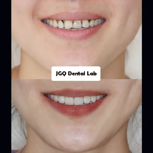 High Translucency Cast Porcelain Emax Veneers China Dental Lab OEM