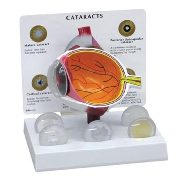Human Eyeball Cataract Anatomy Medical Science Human Eye Anatomy Model