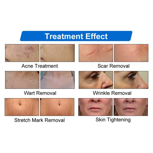 BV13 Portable Co2 Fractional Laser 60W Co2 Fraccionado Laser Vaginal Tightening Co2 Laser Machine For Skin