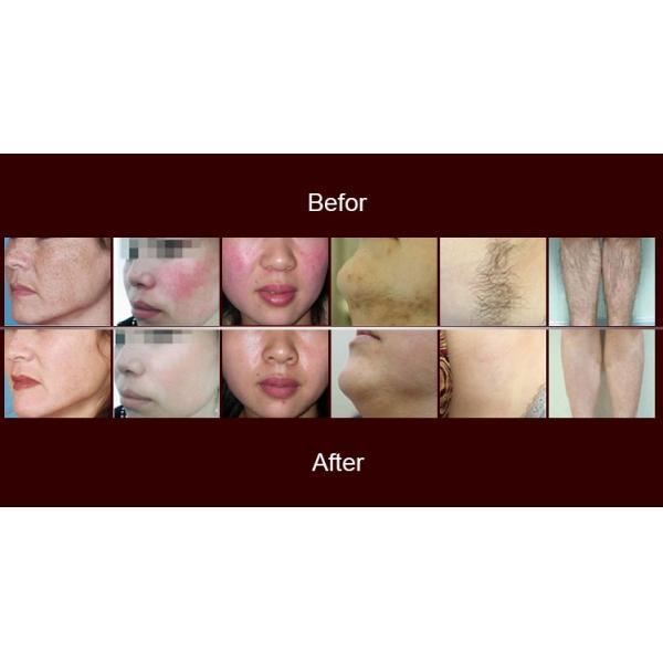 New Style OPT / IPL RF Beauty Equipment SHR IPL Hair Removal 10MHz RF Frequency