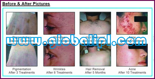 Skin Rejuvenation IPL Hair Removal Machine With 7.4 