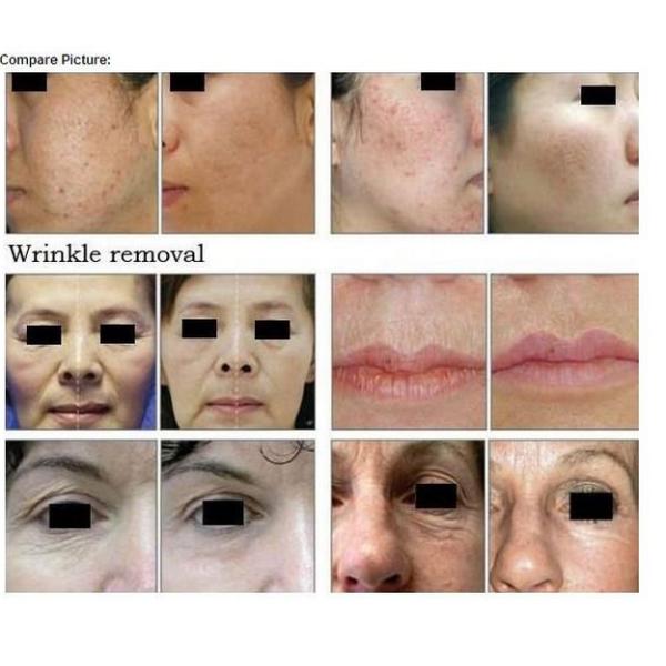 professional fractional co2 laser / skin resurfacing laser / scar removal machine