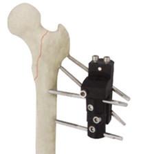 Tipo CE externo femoral Proximal ISO9001 do AO de Orthofix Fixator