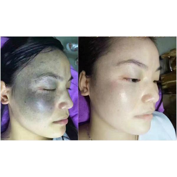 100% 600ps high power Picosecond Laser Korea Pico Laser Machine Tattoo Removal