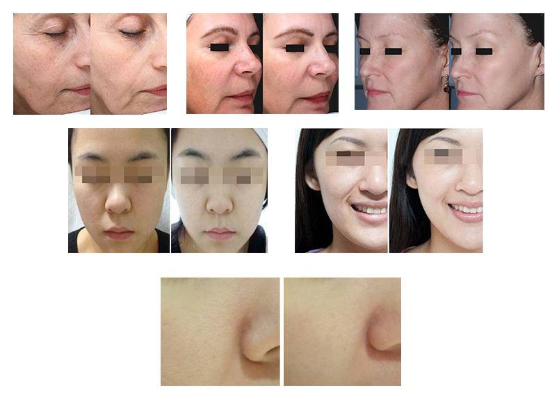 Затягивать кожи частичной радиочастоты микро- Needling