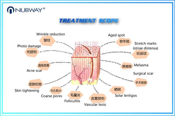 40W 0.10mm RF Pipe laser equipment co2 fractional for Scars Removal