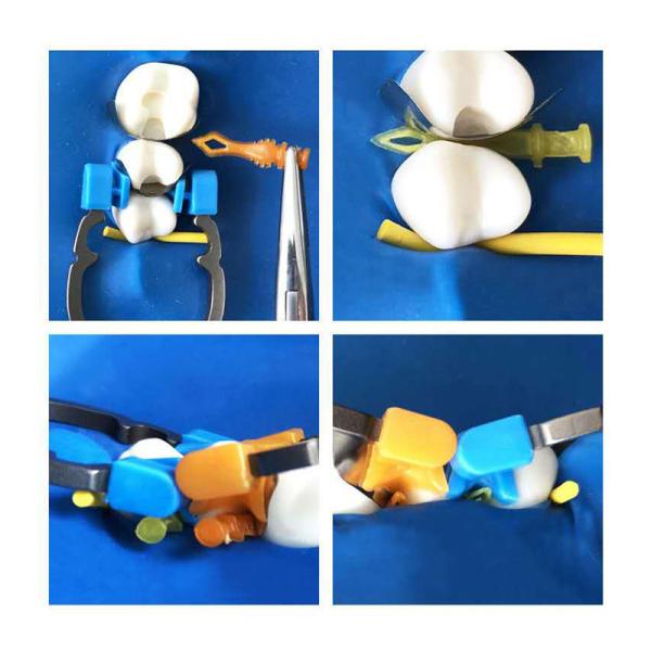 ISO Dental Sectional Matrix System Plastic Matrix Band Diamond Wedges W4 2.0