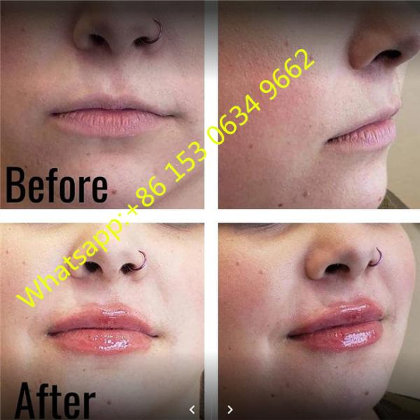 Hyaluronic кисловочный дермальный заполнитель 2ml для пухлого заполнителя губ