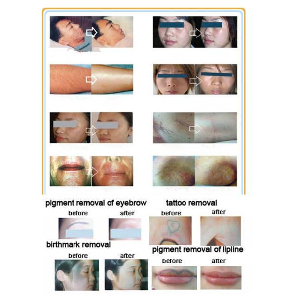 IPL nd yag laser hair removal / tattoo removal machine with Medical CE and ISO