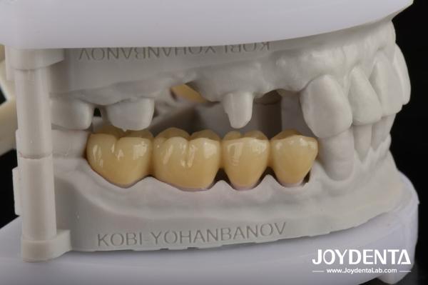 Dentaduras de zirconia que imitan los dientes naturales