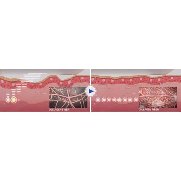 Женская частная машина заботы 3Д ХИФУ, влагалищная затягивая кожа затягивая машину