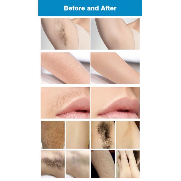 Supplier Dual Wavelength Laser Hair Removal Machine For Remove Tattoos And Pigment