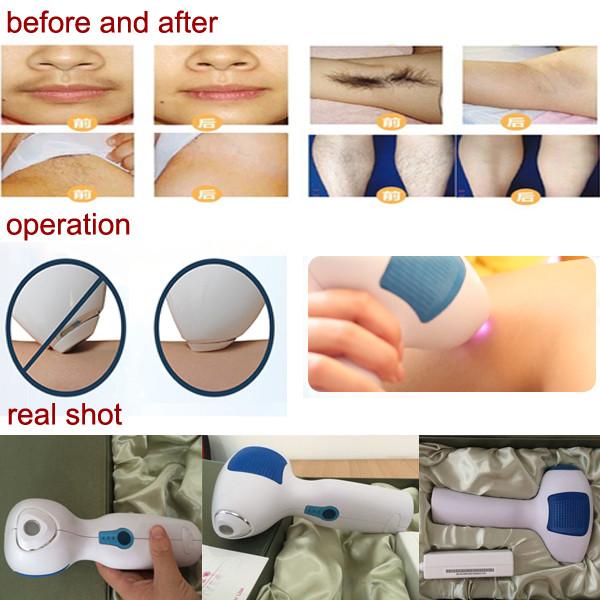 Korea Technology Permanent hair removal MINI 808nm diode laser Home use
