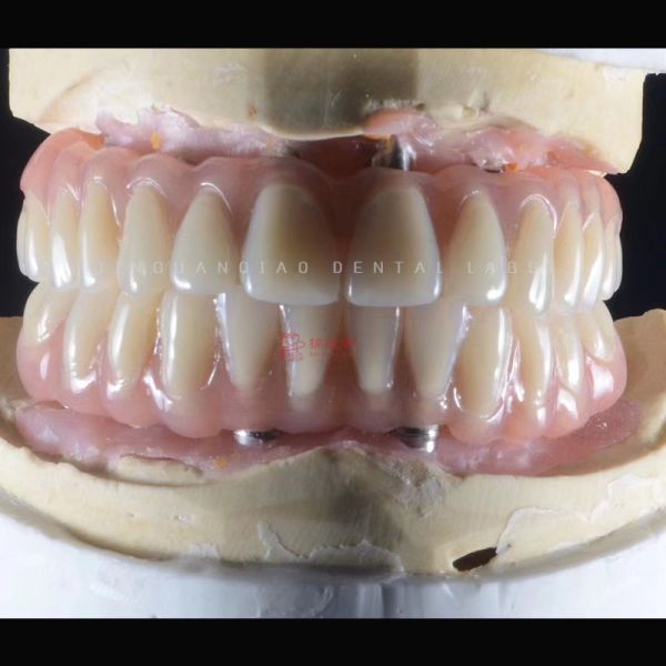 Snap in Implant Dentures Hybrid Dental Implant Restoration Screwed Retention for Dental Lab