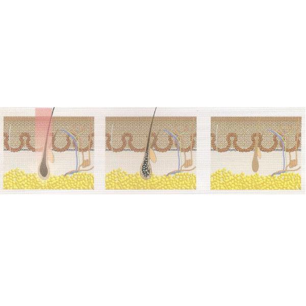 10 Million Shots Hair Removing Laser Machine Painless High Effective