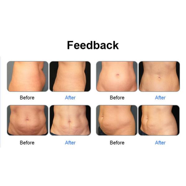 ar da máquina 1-200mw da perda de peso do ultrassom do laser 532nm do diodo 6D de refrigeração