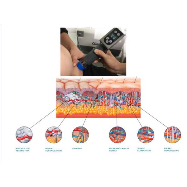 Portable Shock Wave Cryo Therapy Slimming Machine Freezing Fat Machine Therapy For ED ( Erectile Dysfunction) Treatment