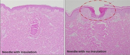 Fractional RF Microneedle For Wrinkle Removal / Skin Tightening