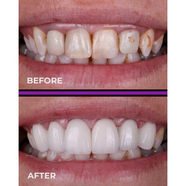 ST Preshade Dental Zirconia Disc 71mm Dental Cad Cam Milling System