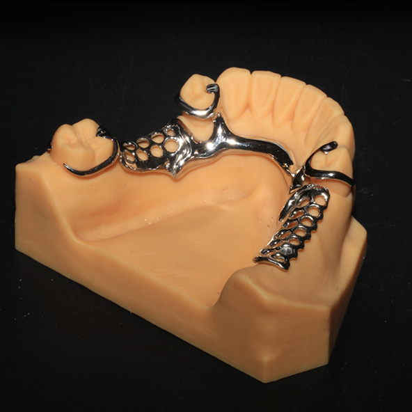 High Strength 3D Printed Argen Dental Framework With Clear Clasps