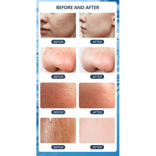 10 In 1 Hydrafacial Machine 350W Hydra Aqua Peel Machine 1 Year Warranty