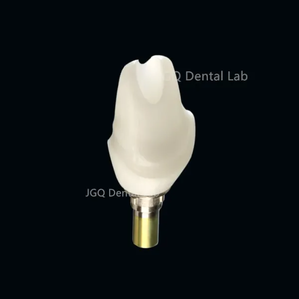 Dental Lab Durability Implants Make Cost-Effective Option in The Long Run