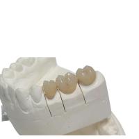 Couronne dentaire provisoire 3D de CFAO PFM imprimant la personnalisation de dentier de conception