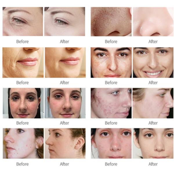 3 In 1 Fractional Co2 Laser Machine Skin Care Vaginal Tightening