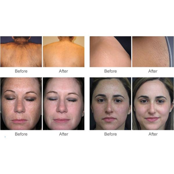 Popular high and Best quality SHR permanent IPL hair removal OPT machine