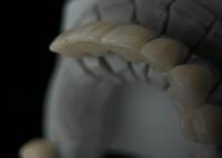 Coroa de dente de zircônio monolítico com translucidez e resistência