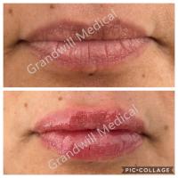 Enchimento cutâneo ácido hialurónico injetável 1ml 2ml do gel do aumento do bordo
