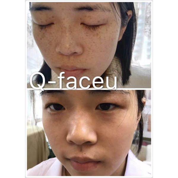 600PS pulsewidth laser tattoo pigment removal skin rejuvenation pico laser machine