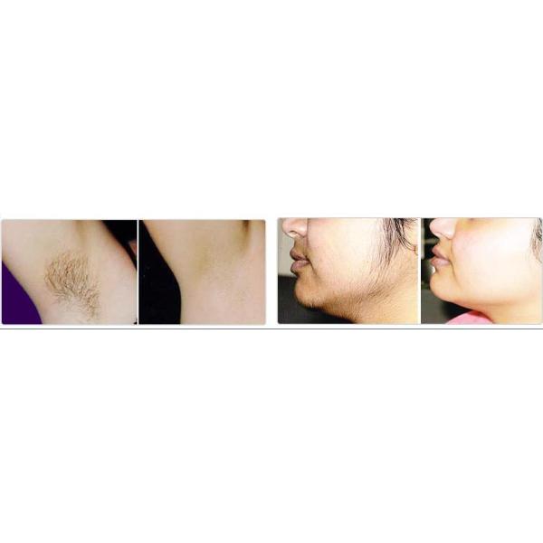 Portable Electric Hair Laser Equipment Esthetic For Leg Hair Removal 55 * 60 * 50cm