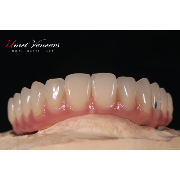 Natural Bright White Veneers