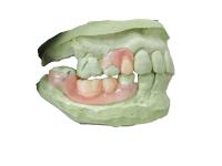 Résine de base de la prothèse flexible pour la restauration partiellement dentée Stable et confortable