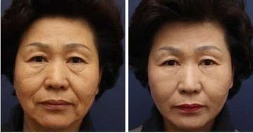 Best Sell Forimi Medical Aesthetic Professional Korea Focused Ultrasound Hifu For Face Lift Skin Tightening Skin