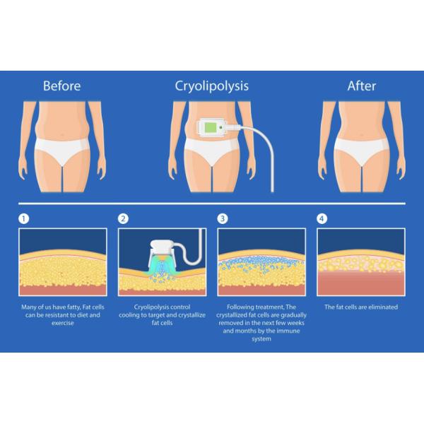 Lcd Cryolipolysis уменьшая вакуум портативной машинки 650nm жирный замерзая уменьшая машину