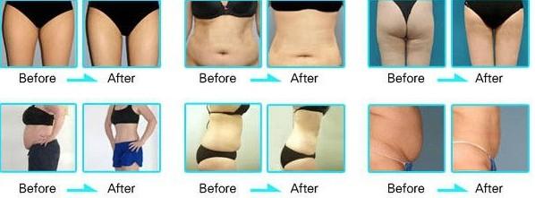 new design type Vacuum Cavitation System for weight loss
