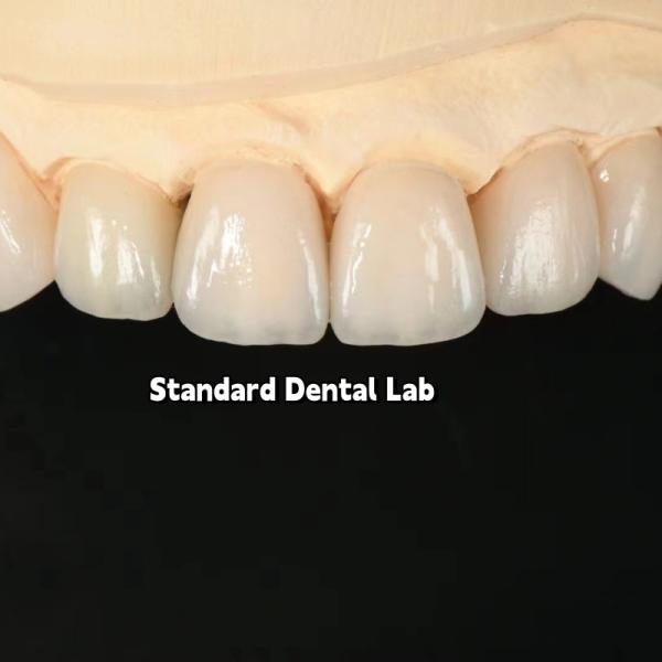 Высококачественная зубная цирконовая корона и All On Four Six Implant Full Arch / Китайская стоматологическая лаборатория