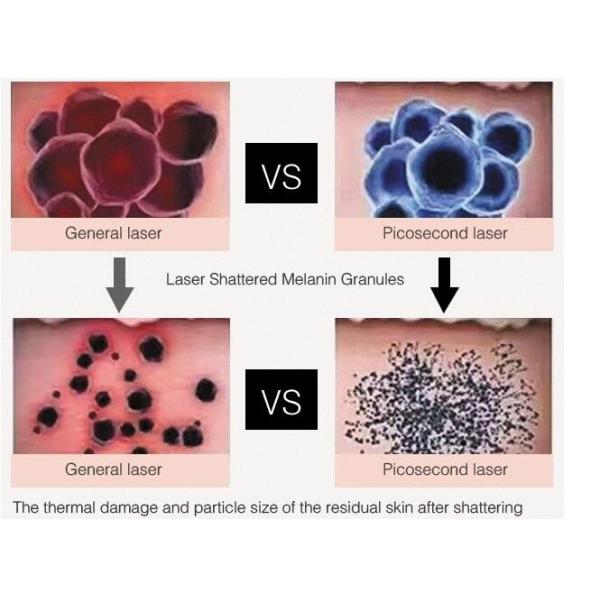 Portable Picosure Laser Machine , 755nm Picosecond Yag Tattoo Removal Machines