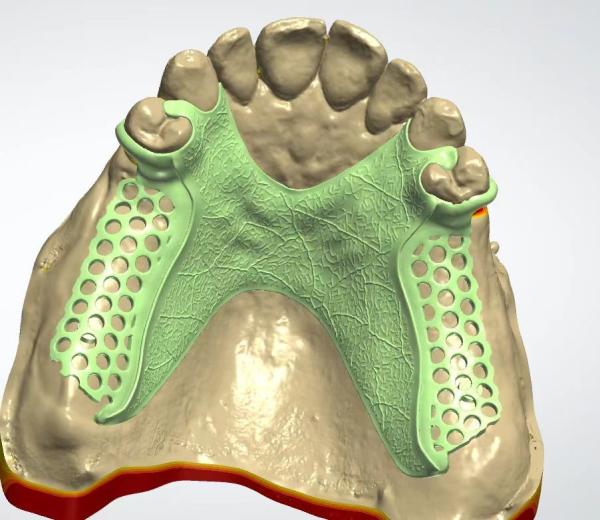 Digital Metal Framework CAD CAM Dental Design Cocr Material With 3D Printing