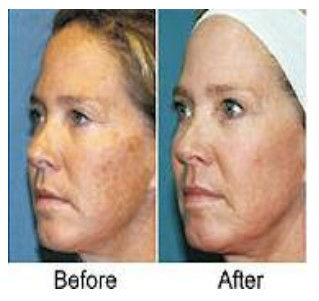 5mhz Touch High Quality Screen Thermage Skin Treatment Machine Nubway