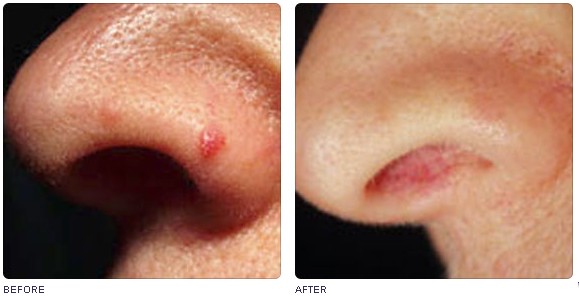 Arm YAG laser with 7 joints for pigment removal,tattoo Removal, birthmark removal etc.