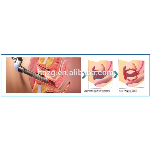 Vagina Tightening Beauty Therapy Equipment Scar Removal RF Fractional Co2 Laser Machine
