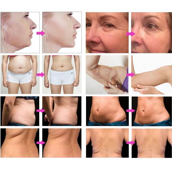 Ультра тонкое уменьшение поднимаясь тела стороны машины 7D патрона HIFU лицевое